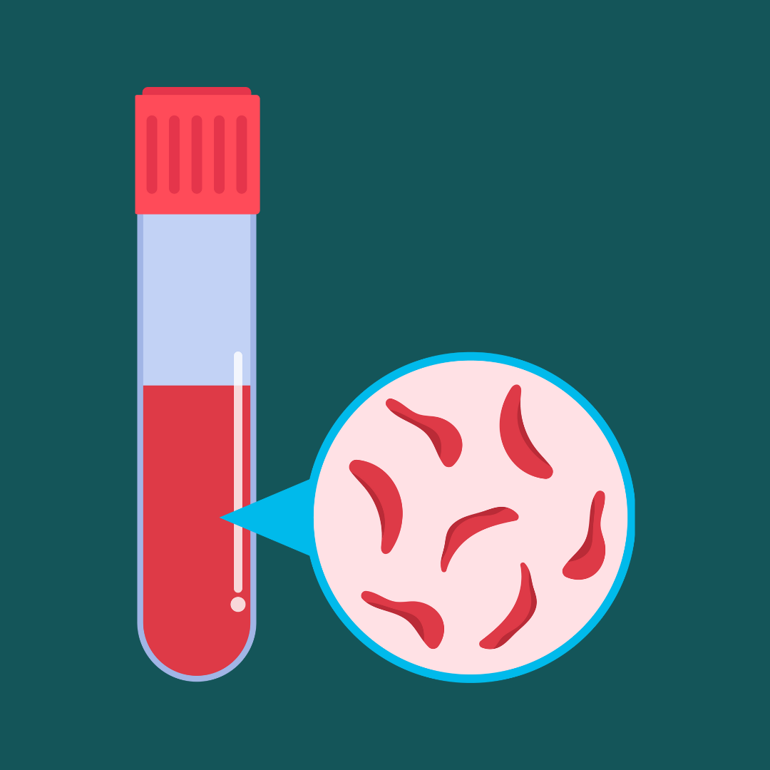 sickle cell in test tube