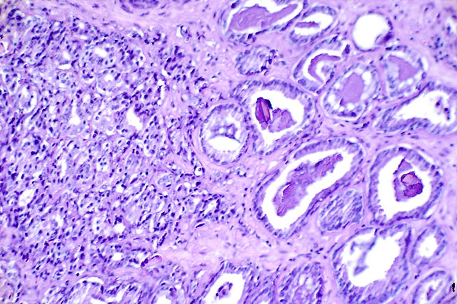 Microscope image of purple cells displaying prostate cancer.