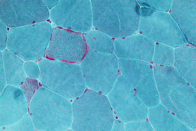 Image is of stained cells (blue) highlighting diseased mitochondria (red).