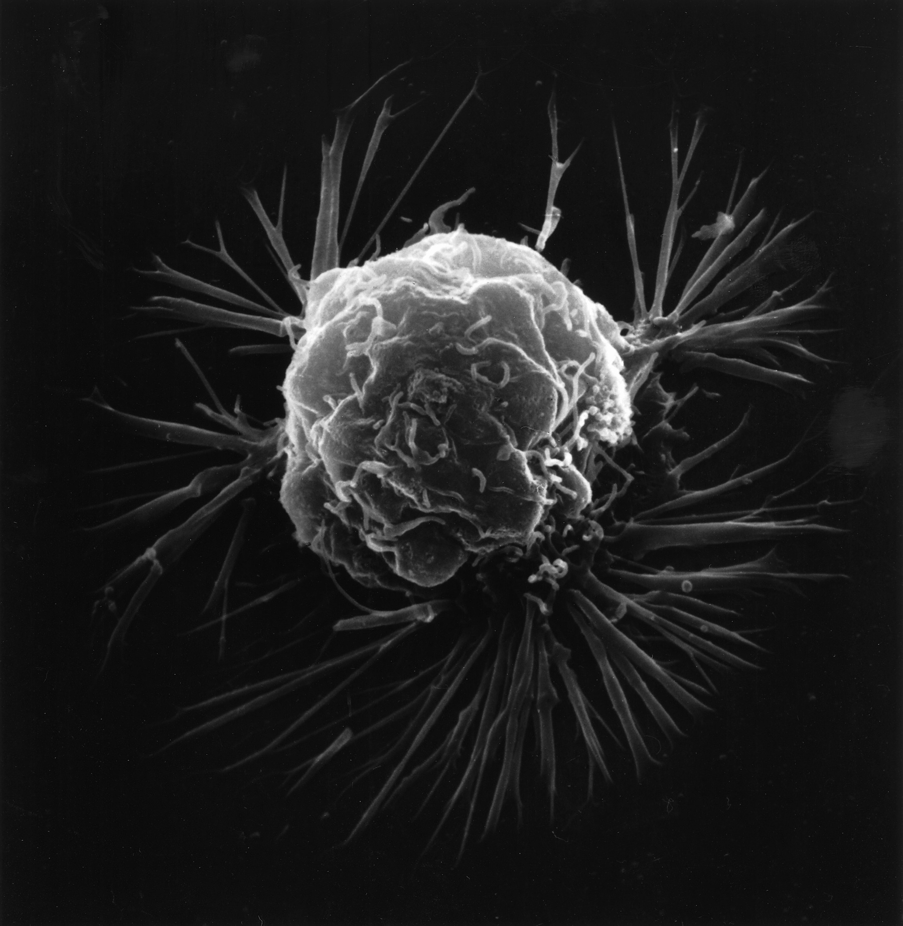 A breast cancer cell, captured in black and white by an electron microscope