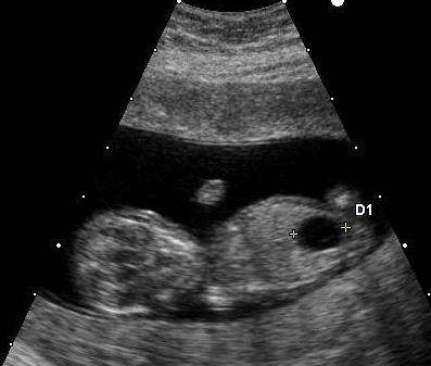 Ultrasound of child with down syndrome