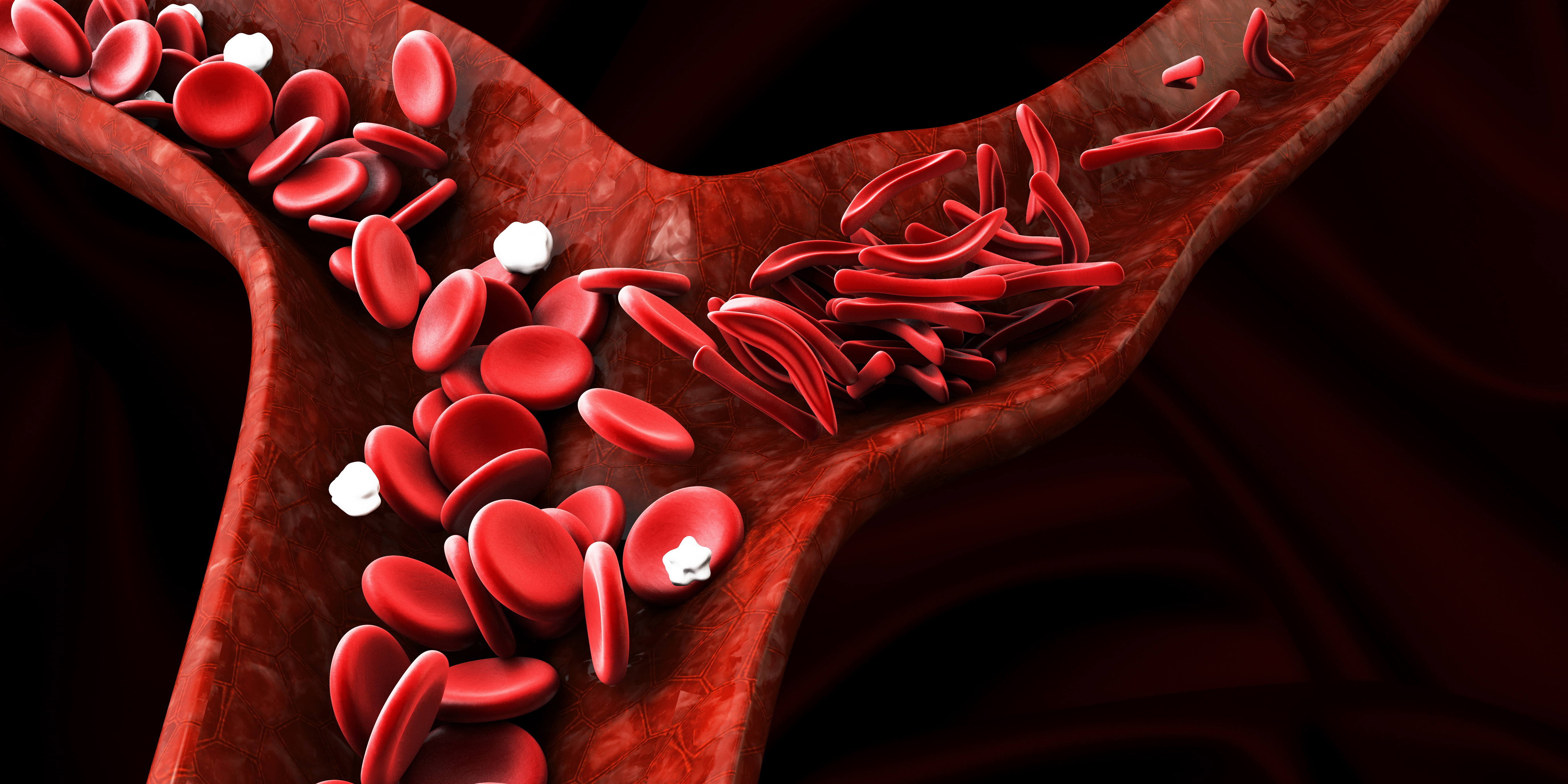 Sickle cell anemia, showing blood vessel with normal and deformated crescent