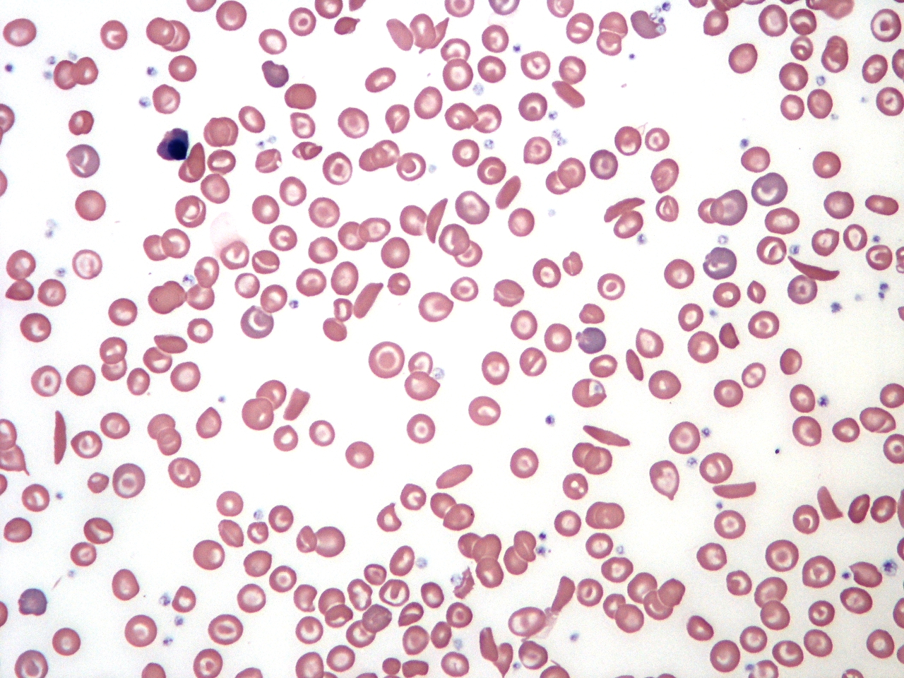 Sickle cell anemia blood under microscope