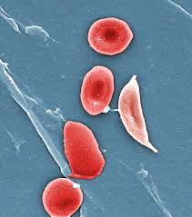 Three round red blood cells and two sickle shaped on blue background