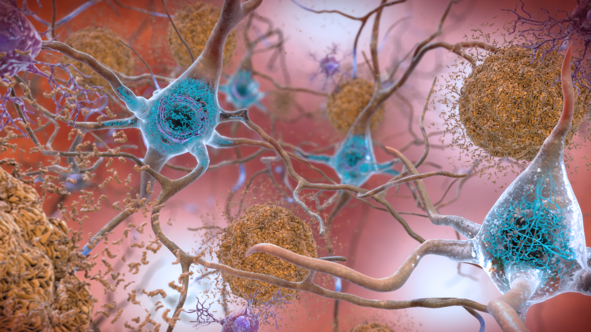 Placque-ridden neurons in a brain affected by Alzheimer's