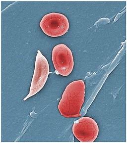 Images of  cells, including sickle cell