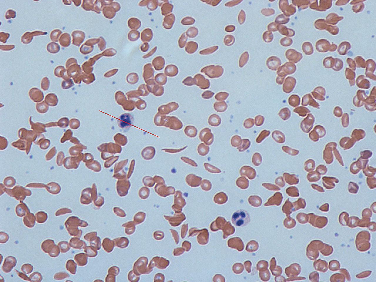 A series of red blood cells, some are sickle shaped