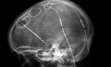 Deep brain stimulation, image via Wikimedia. Deep brain stimulation, image via Wikimedia.