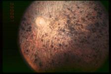 Figure 3. Fundus of patient with retinitis pigmentosa, end stage (Pigment deposits are present all over the retina. Retinal vessels are very thin and optic disc is pale.) Hamel Orphanet Journal of Rare Diseases 2006 1:40 doi:10.1186/1750-1172-1-40 (Wikimedia)