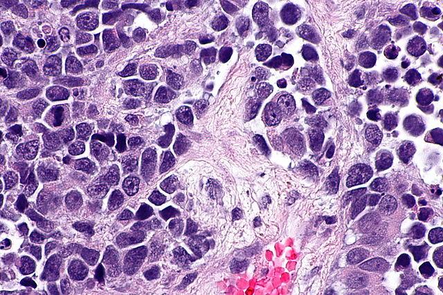 purple cancer cells