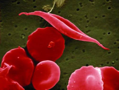 a sickle cell red blood cell with its characteristic shape