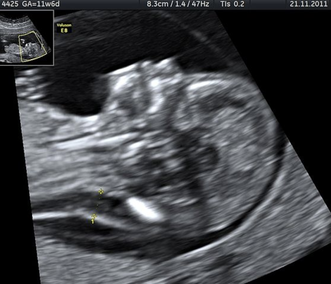 Ultrasound image of a baby's head in black and white showing absent nasal bone indicating Down Syndrome.